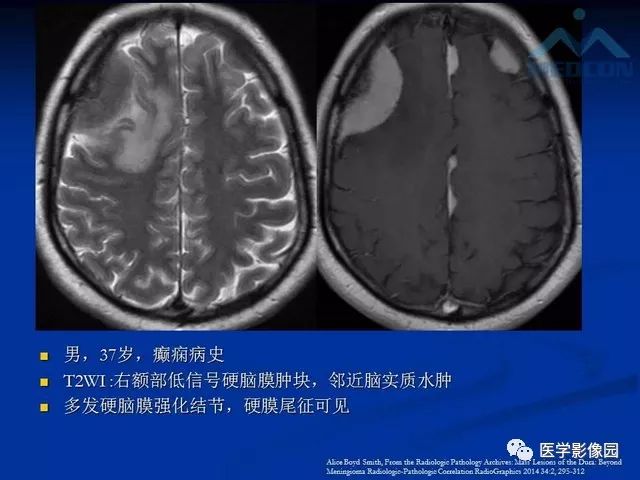 【PPT】脑膜瘤以外的硬脑膜肿块：影像学表现与鉴别诊断