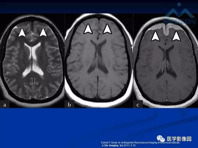 【PPT】脑膜瘤以外的硬脑膜肿块：影像学表现与鉴别诊断