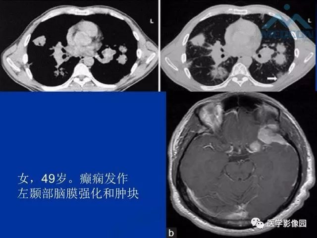 【PPT】脑膜瘤以外的硬脑膜肿块：影像学表现与鉴别诊断