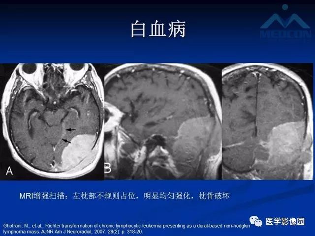 【PPT】脑膜瘤以外的硬脑膜肿块：影像学表现与鉴别诊断