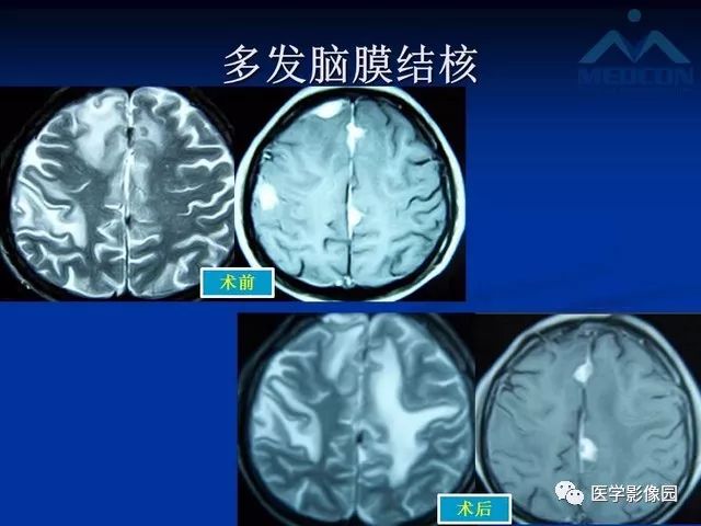 【PPT】脑膜瘤以外的硬脑膜肿块：影像学表现与鉴别诊断