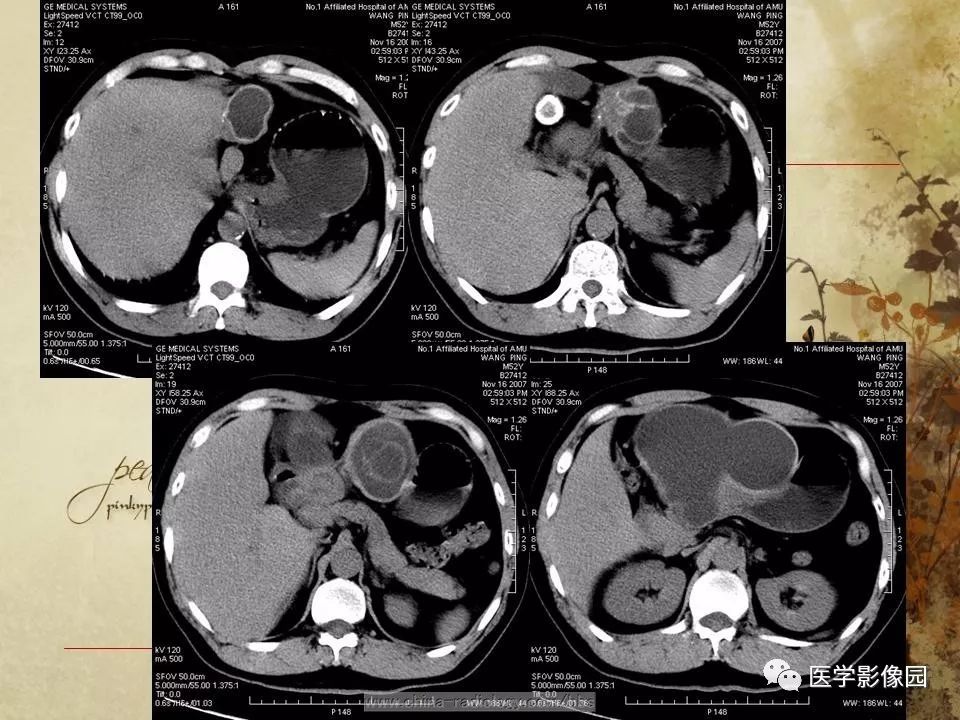 【病例】腹腔包虫病1例CT影像表现