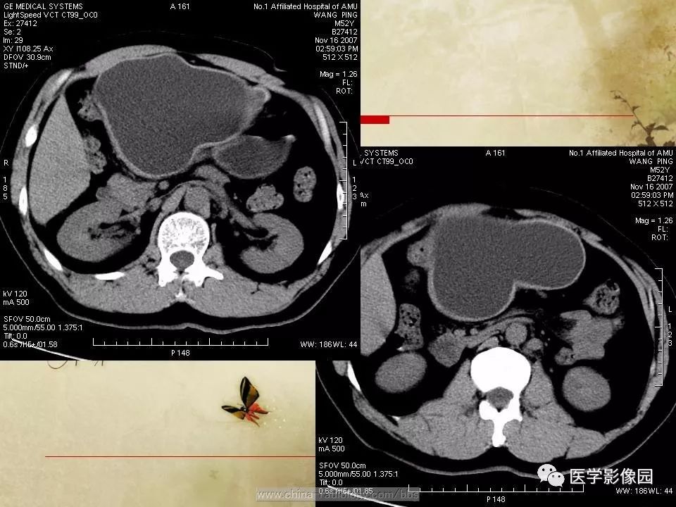 【病例】腹腔包虫病1例CT影像表现