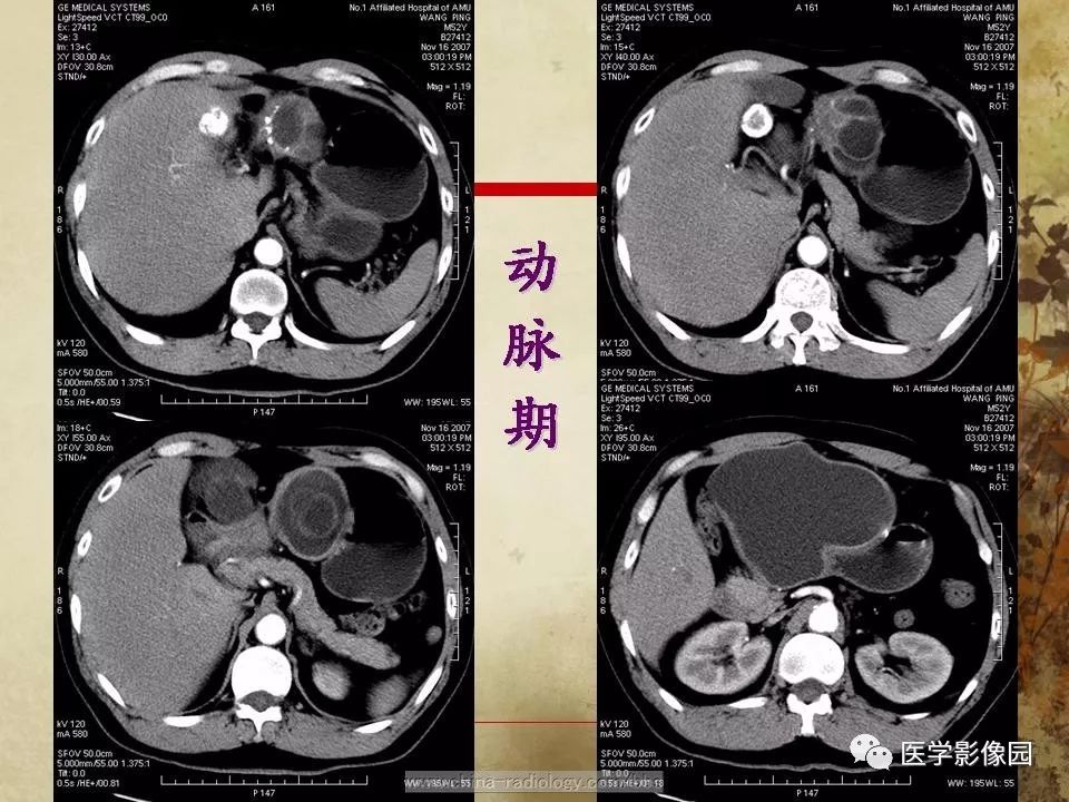 【病例】腹腔包虫病1例CT影像表现
