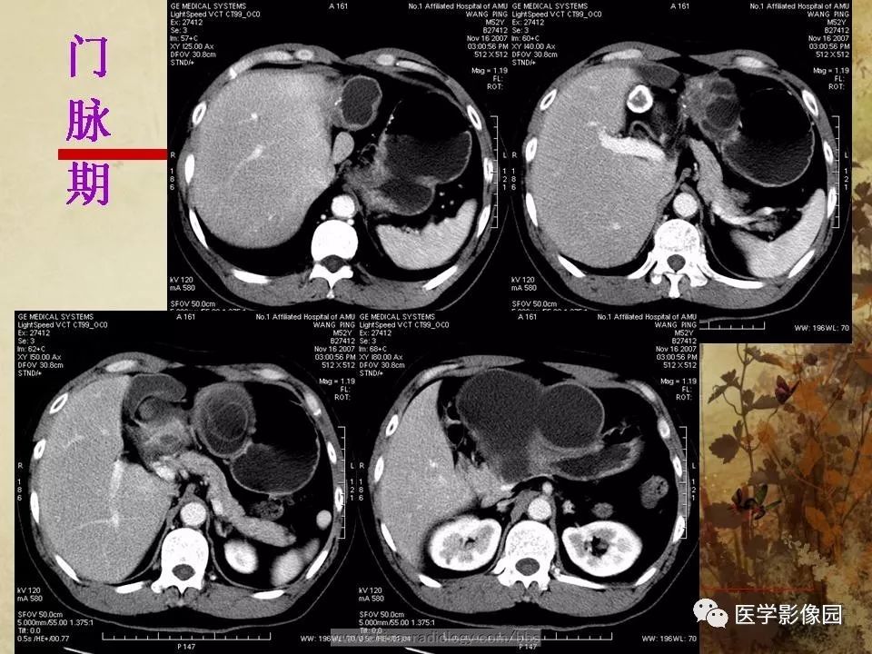 【病例】腹腔包虫病1例CT影像表现