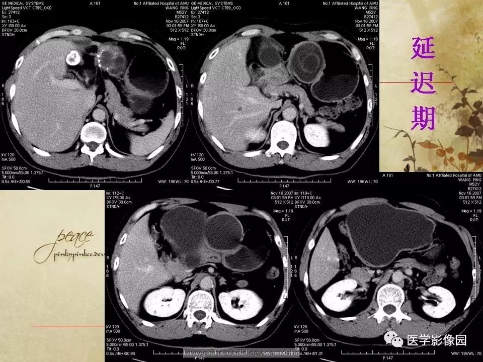 【病例】腹腔包虫病1例CT影像表现