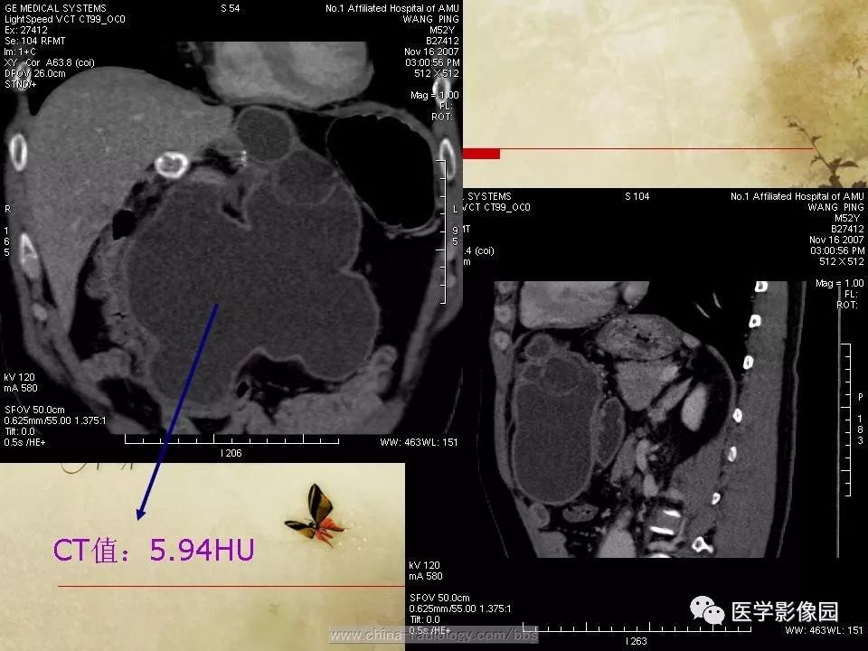 【病例】腹腔包虫病1例CT影像表现