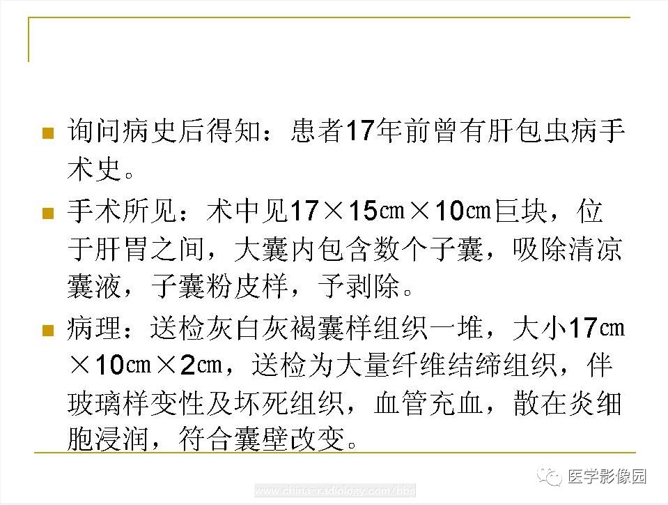 【病例】腹腔包虫病1例CT影像表现