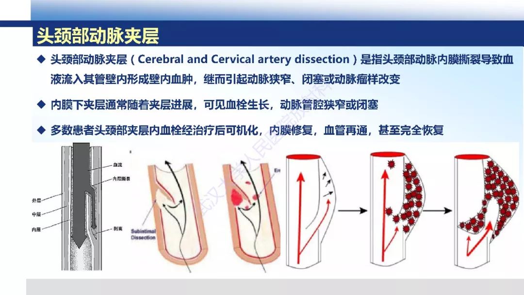 【PPT】头颈部动脉夹层影像诊断