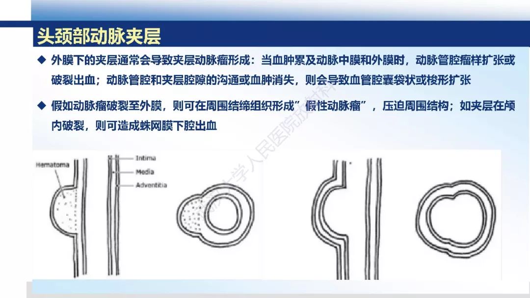 【PPT】头颈部动脉夹层影像诊断