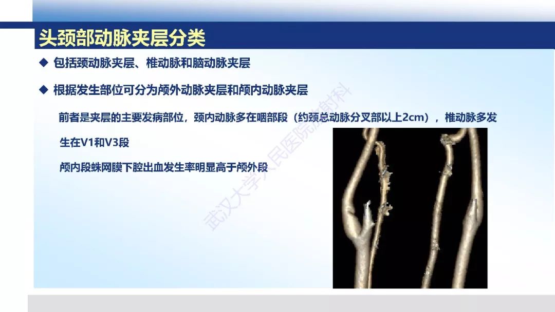 【PPT】头颈部动脉夹层影像诊断