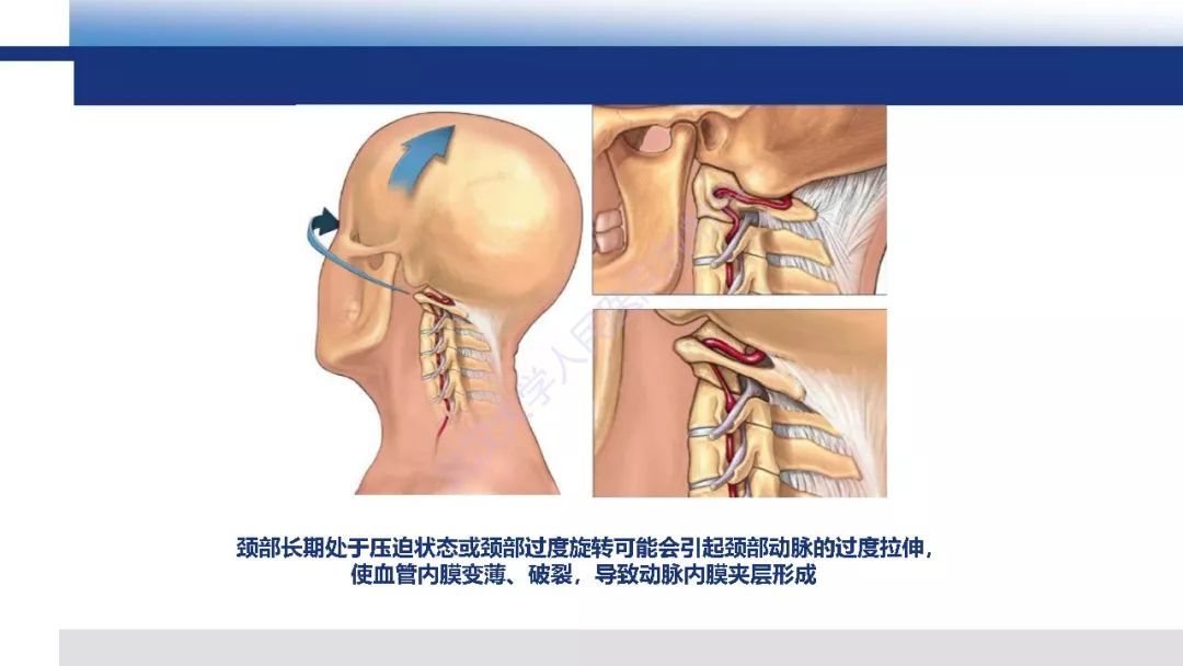 【PPT】头颈部动脉夹层影像诊断