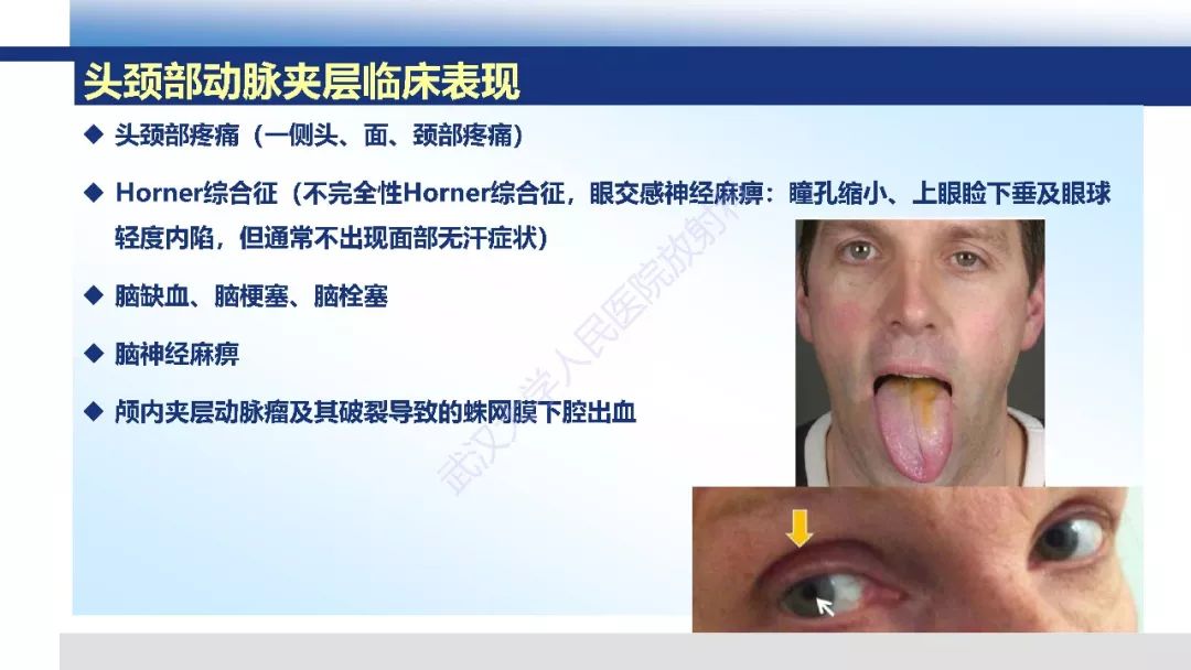 【PPT】头颈部动脉夹层影像诊断