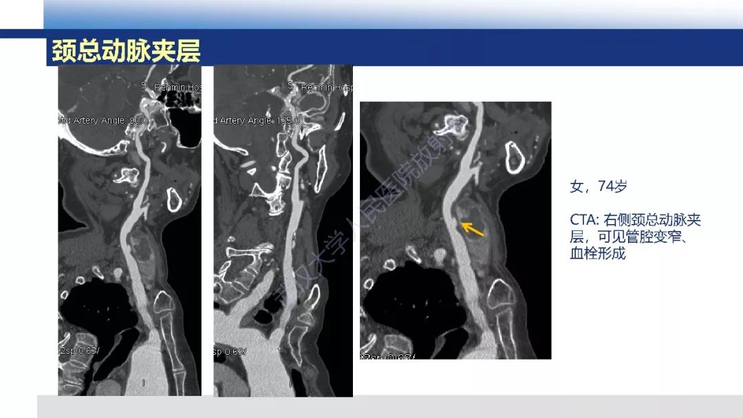 【PPT】头颈部动脉夹层影像诊断