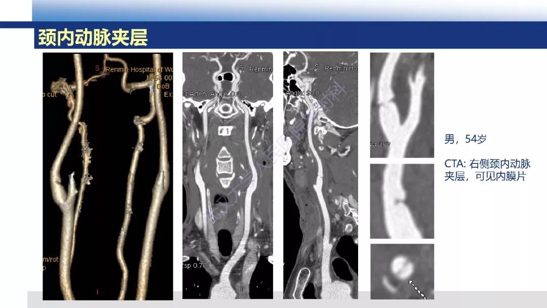 【PPT】头颈部动脉夹层影像诊断