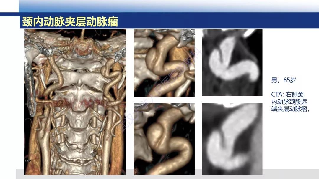 【PPT】头颈部动脉夹层影像诊断
