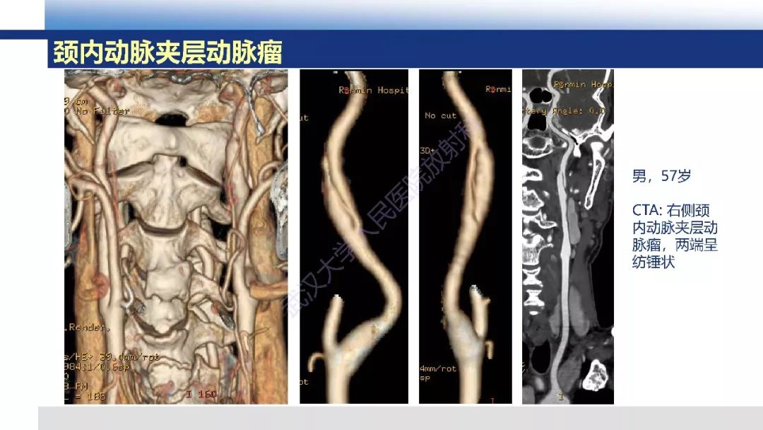 【PPT】头颈部动脉夹层影像诊断