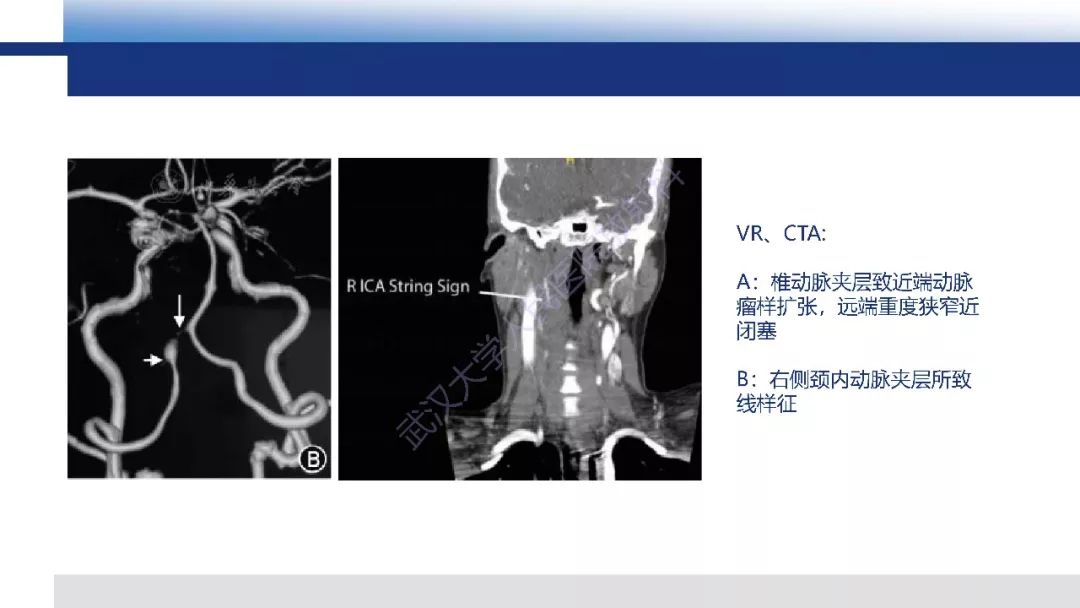 【PPT】头颈部动脉夹层影像诊断