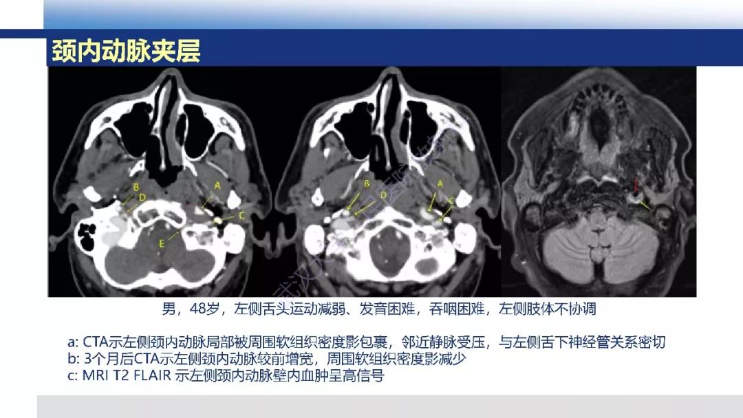 【PPT】头颈部动脉夹层影像诊断