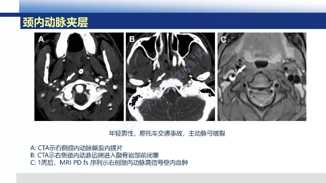 【PPT】头颈部动脉夹层影像诊断