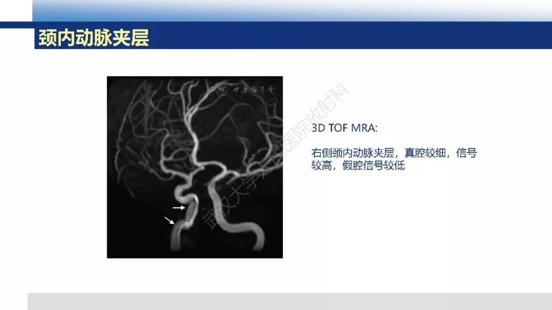 【PPT】头颈部动脉夹层影像诊断