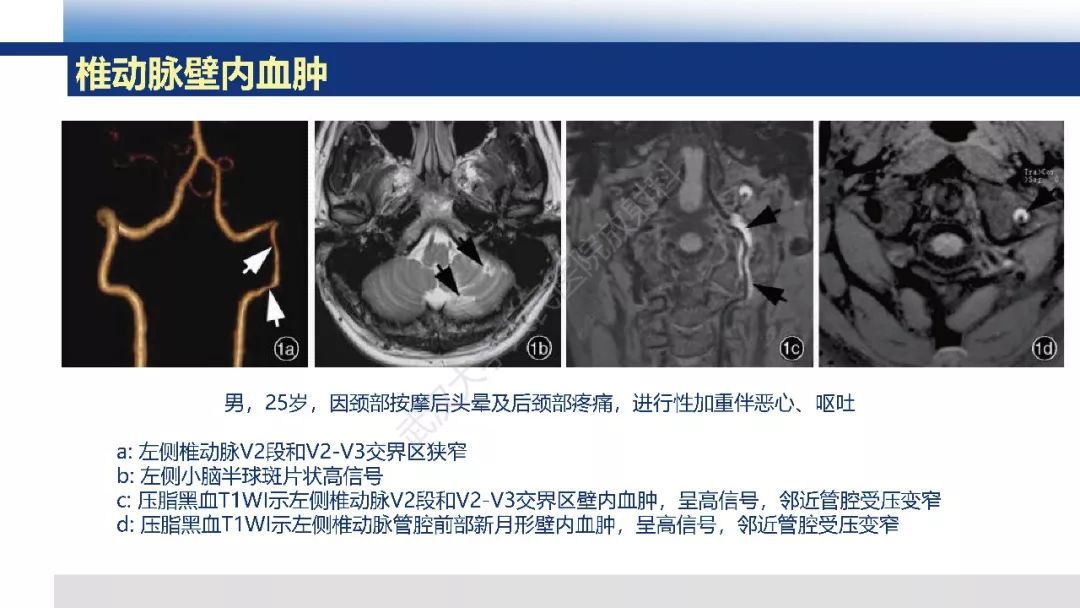【PPT】头颈部动脉夹层影像诊断