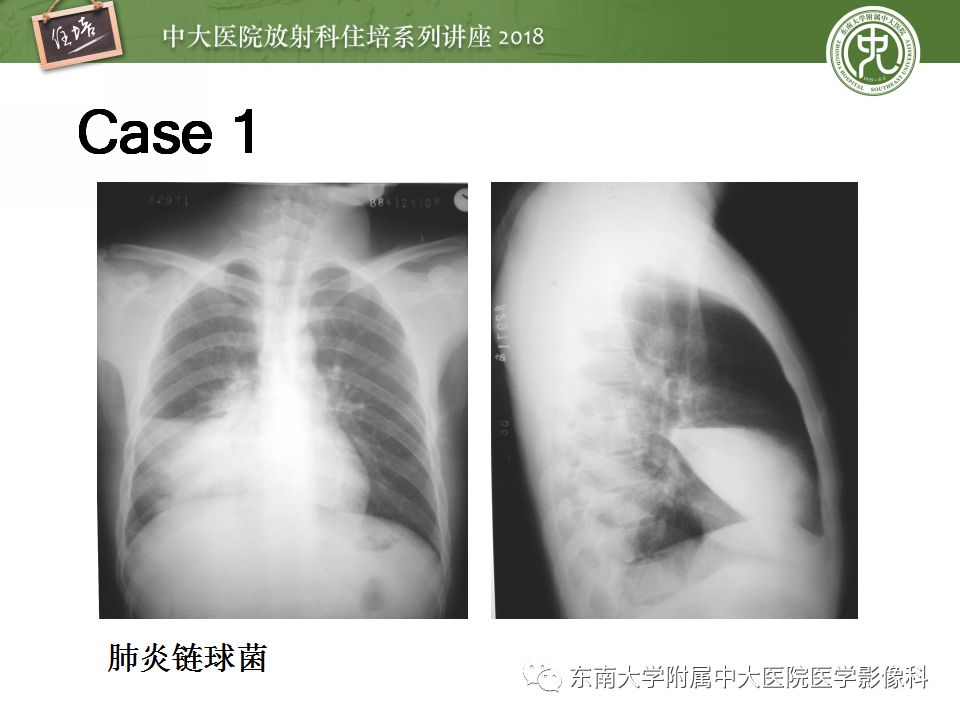 【PPT】肺部感染性疾病影像诊断及鉴别（一）