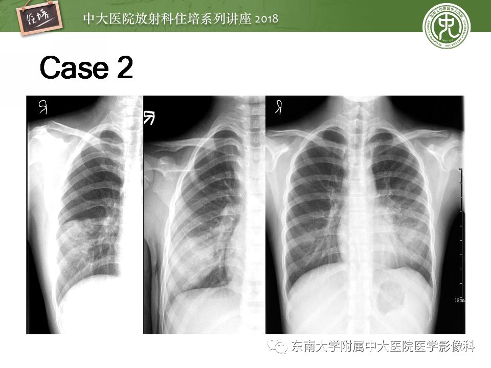 【PPT】肺部感染性疾病影像诊断及鉴别（一）