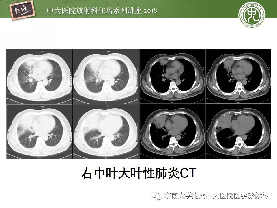 【PPT】肺部感染性疾病影像诊断及鉴别（一）