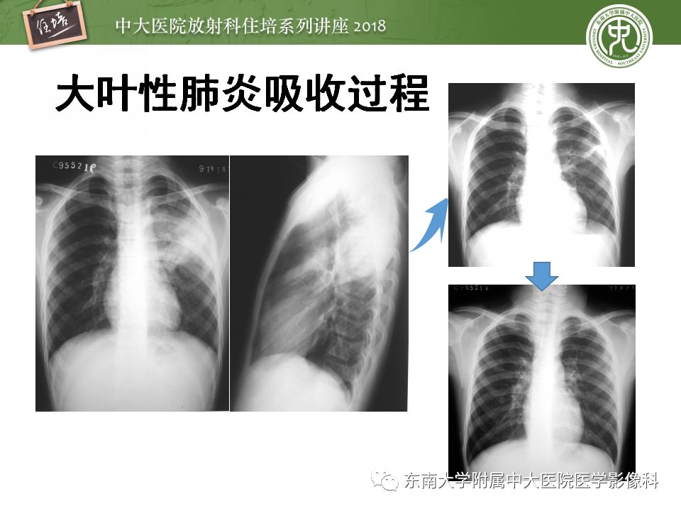 【PPT】肺部感染性疾病影像诊断及鉴别（一）