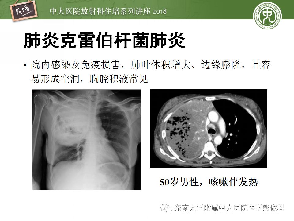 【PPT】肺部感染性疾病影像诊断及鉴别（一）
