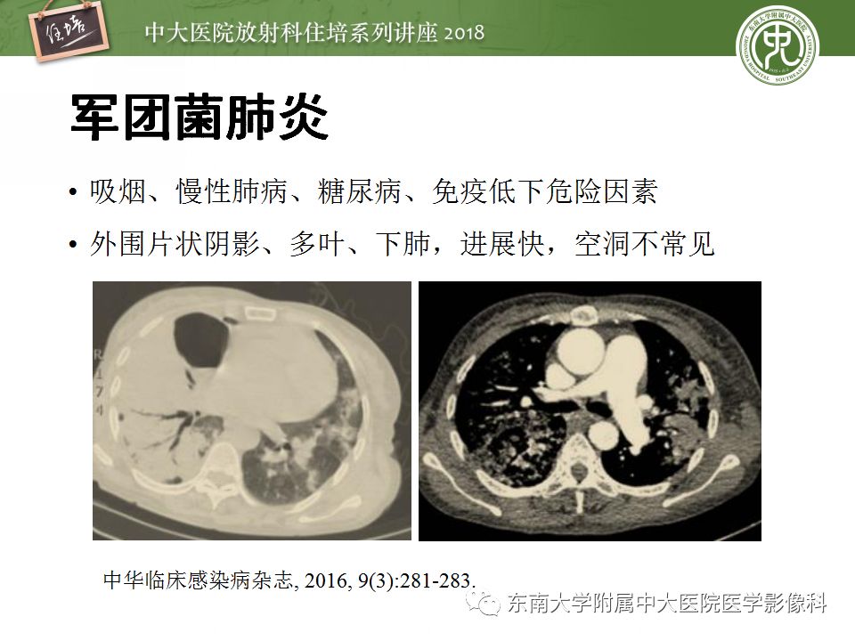 【PPT】肺部感染性疾病影像诊断及鉴别（一）