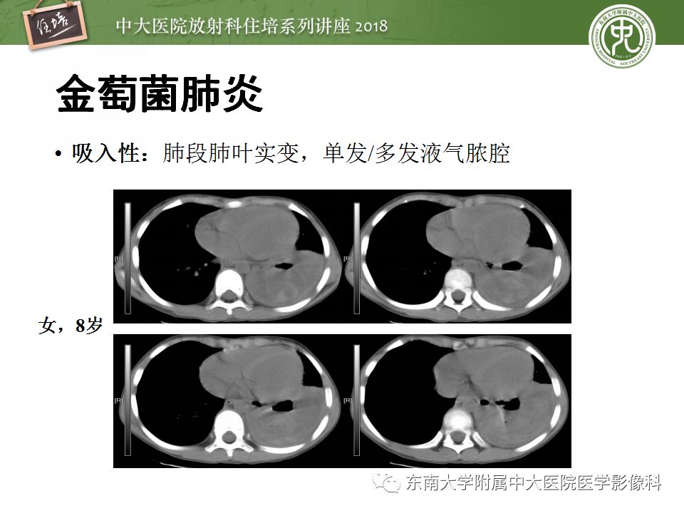 【PPT】肺部感染性疾病影像诊断及鉴别（一）
