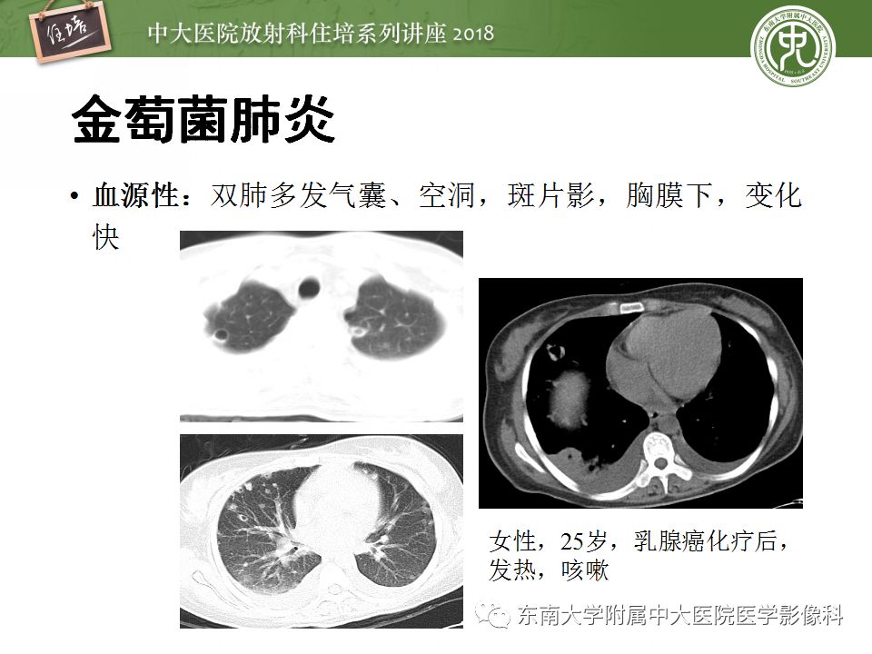 【PPT】肺部感染性疾病影像诊断及鉴别（一）