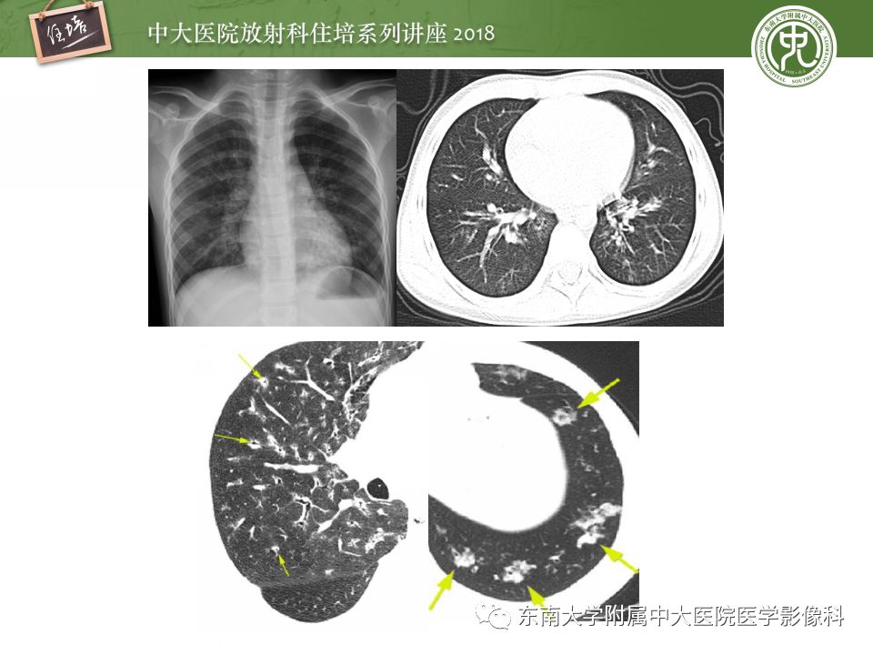 【PPT】肺部感染性疾病影像诊断及鉴别（一）