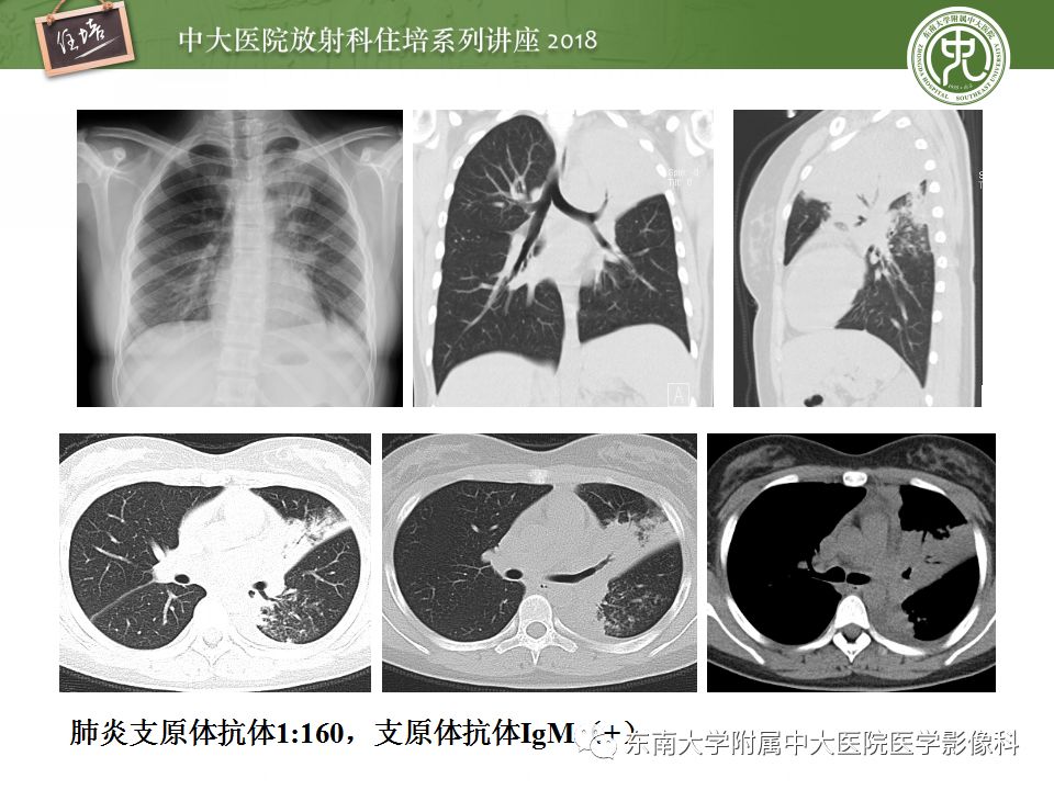 【PPT】肺部感染性疾病影像诊断及鉴别（一）