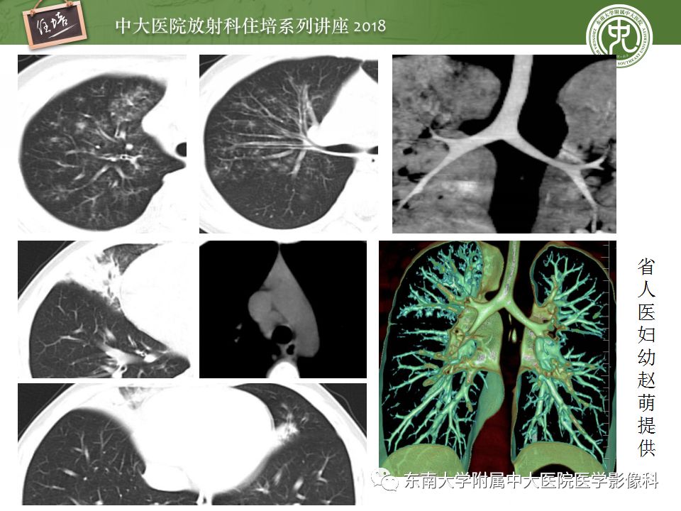 【PPT】肺部感染性疾病影像诊断及鉴别（一）