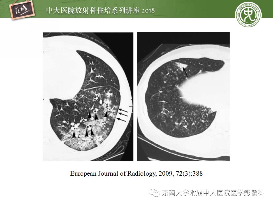 【PPT】肺部感染性疾病影像诊断及鉴别（一）
