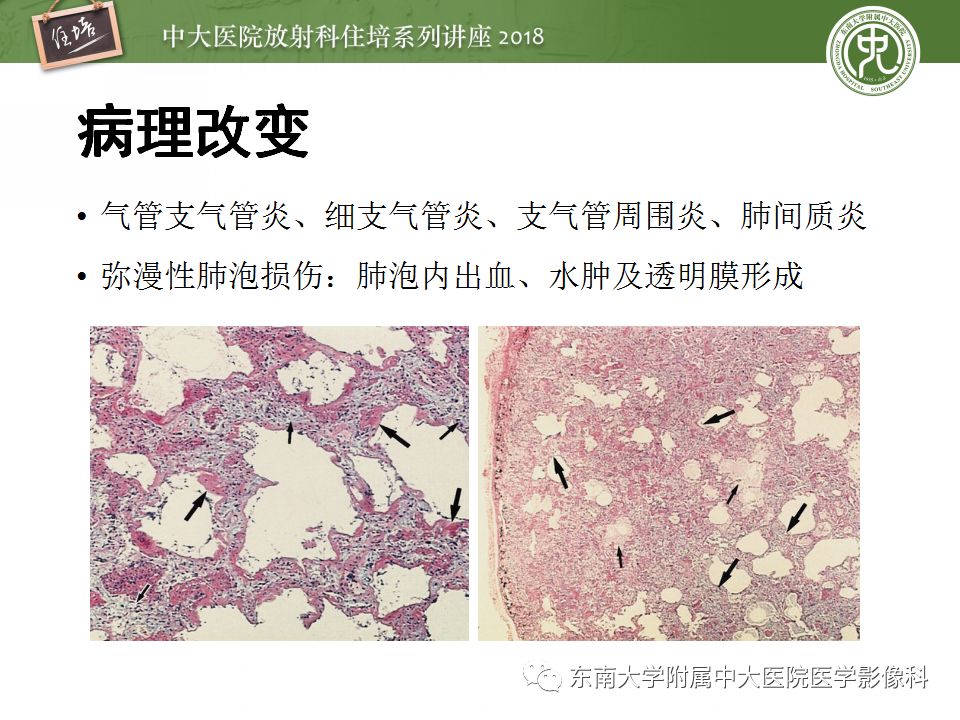 【PPT】肺部感染性疾病影像诊断及鉴别（一）