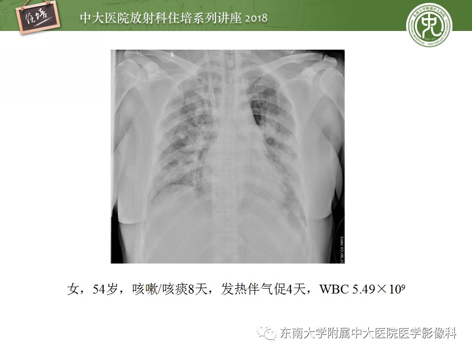 【PPT】肺部感染性疾病影像诊断及鉴别（一）