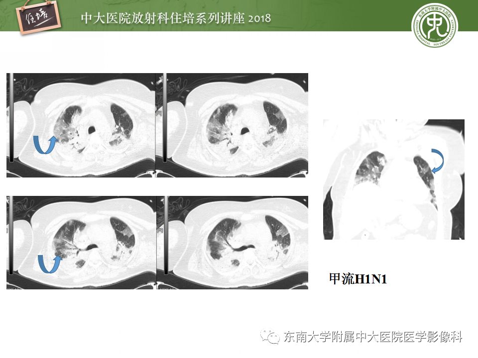 【PPT】肺部感染性疾病影像诊断及鉴别（一）