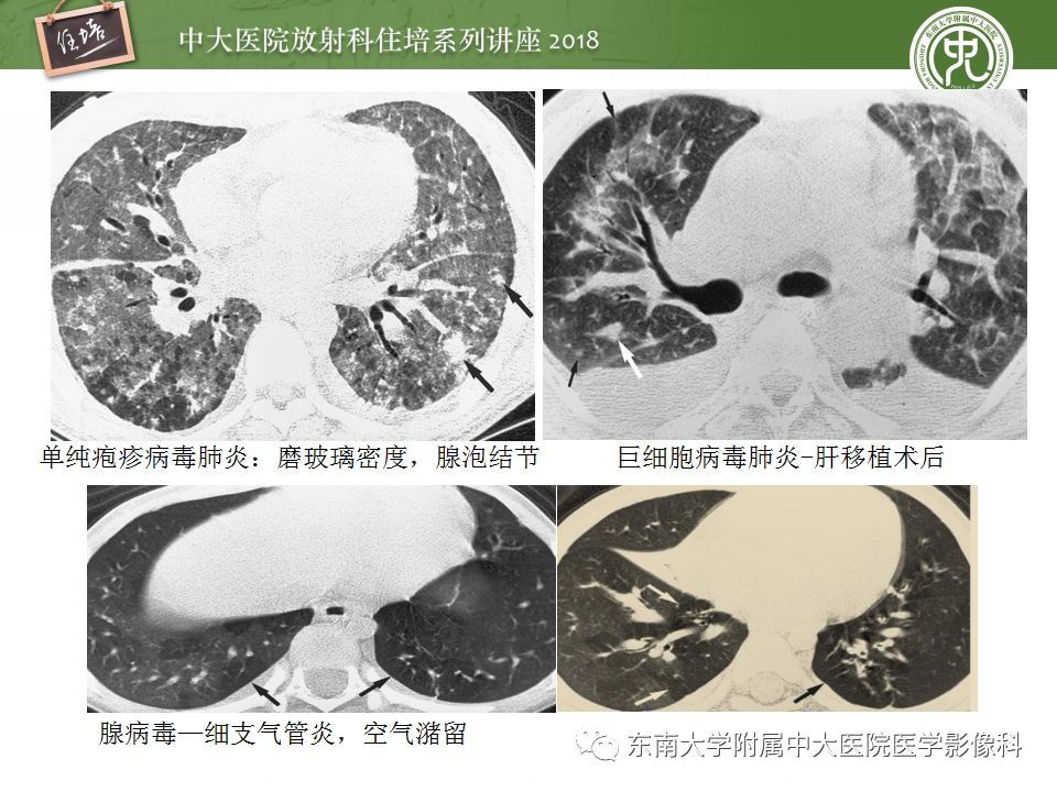 【PPT】肺部感染性疾病影像诊断及鉴别（一）