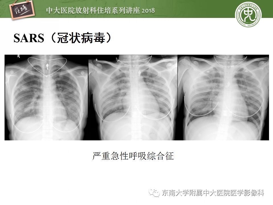 【PPT】肺部感染性疾病影像诊断及鉴别（一）