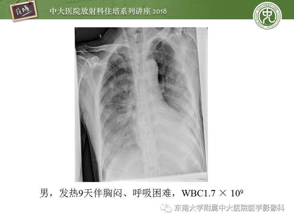 【PPT】肺部感染性疾病影像诊断及鉴别（一）