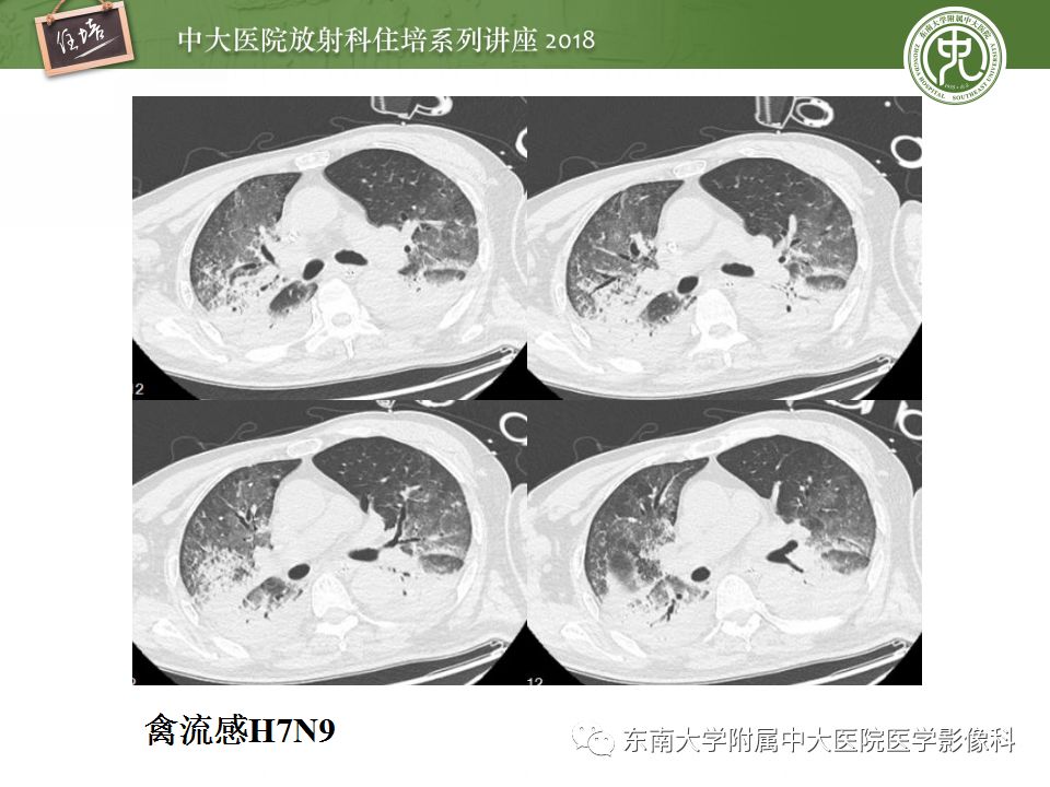 【PPT】肺部感染性疾病影像诊断及鉴别（一）