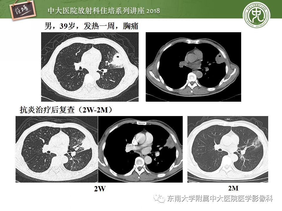 【PPT】肺部感染性疾病影像诊断及鉴别（一）