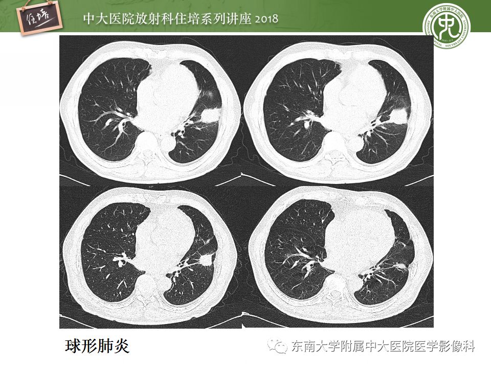 【PPT】肺部感染性疾病影像诊断及鉴别（一）