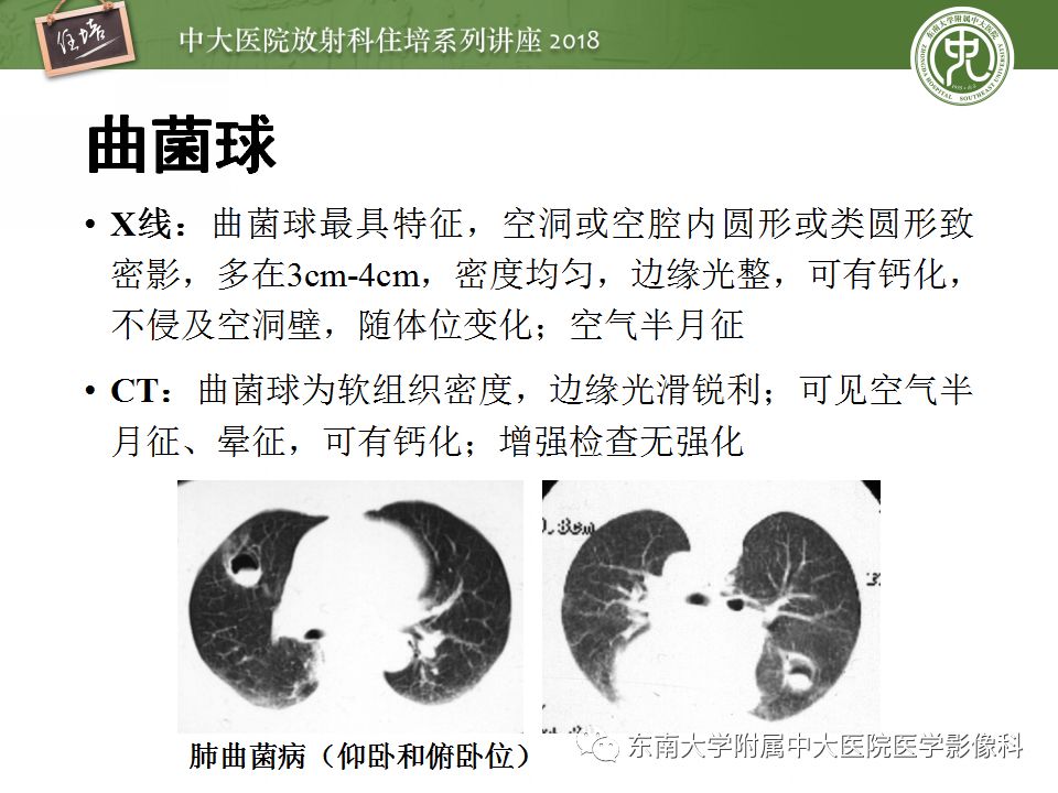 【PPT】肺部感染性疾病影像诊断及鉴别（一）