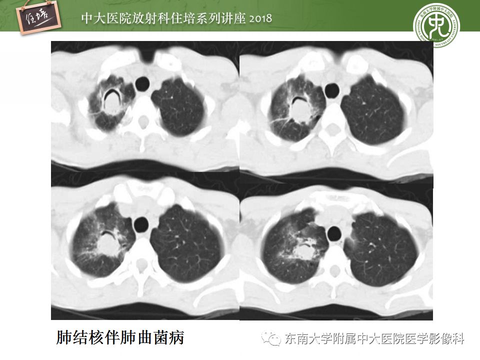 【PPT】肺部感染性疾病影像诊断及鉴别（一）