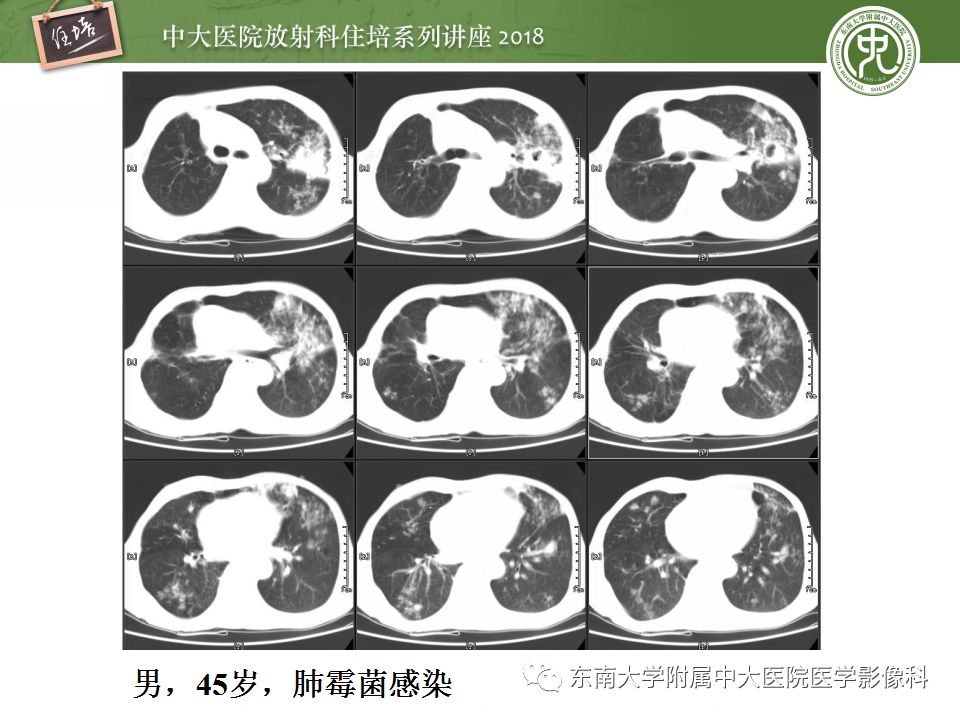 【PPT】肺部感染性疾病影像诊断及鉴别（一）